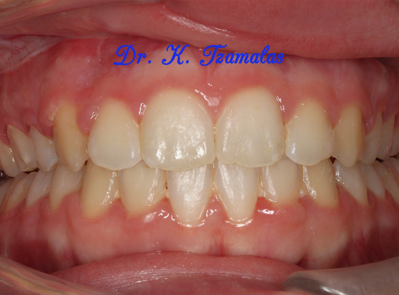 Συνδυαστική Ορθοδοντική / Ορθογναθική θεραπεία - Athens Orthodontics | Dr. Κωνσταντίνος Τζαμάλας